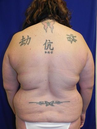 Body Tummy Tuck / Abdominoplasty: Case 14 (19509) - Before