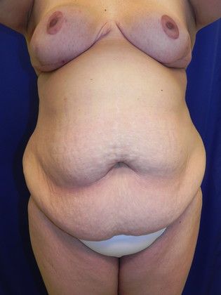 Body Tummy Tuck / Abdominoplasty Case 14 (19509) - Before