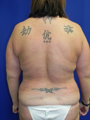 Body Tummy Tuck / Abdominoplasty: Case 14 (19509) - After