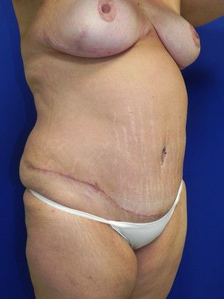 Body Tummy Tuck / Abdominoplasty: Case 14 (19509) - After