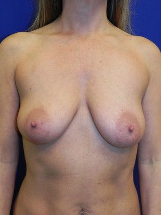 Body Mommy Make-Over: Case 2 (20334) - Before