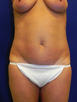 Body Mommy Make-Over: Case 2 (20334) - Before