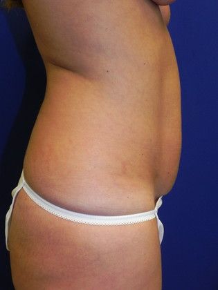 Body Mommy Make-Over: Case 2 (20334) - Before