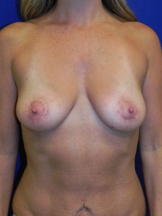 Body Mommy Make-Over: Case 2 (20334) - After