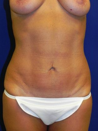 Body Mommy Make-Over: Case 2 (20334) - After