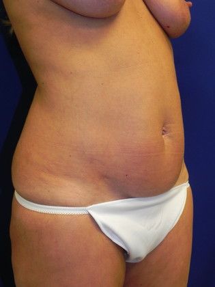 Body Tummy Tuck / Abdominoplasty: Case 15 (20334) - After