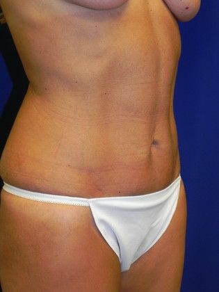 Body Tummy Tuck / Abdominoplasty: Case 15 (20334) - Before