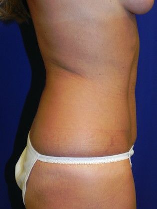 Body Tummy Tuck / Abdominoplasty: Case 15 (20334) - After