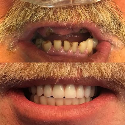 Case 16 - New Teeth with Permanent Implants in Texas Panhandle - All on