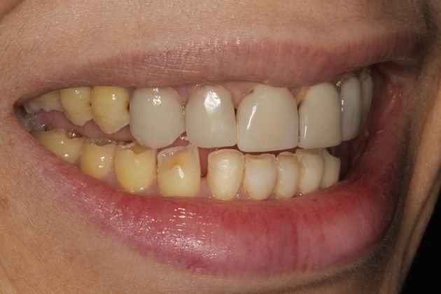 Full Mouth Rehabilitation: Severe Tooth Wear - Before