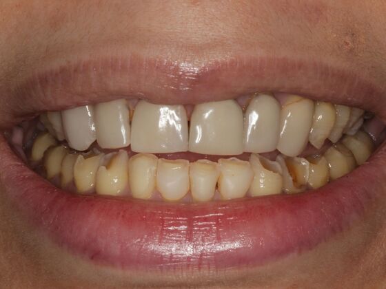 Full Mouth Rehabilitation Case 3 - Before