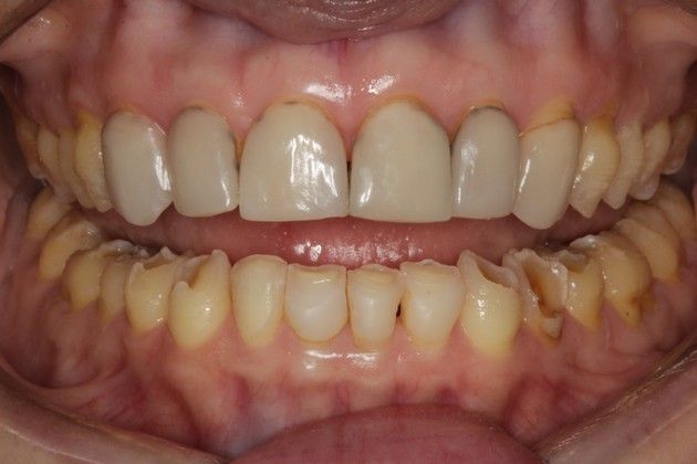 Full Mouth Rehabilitation: Severe Tooth Wear - Before