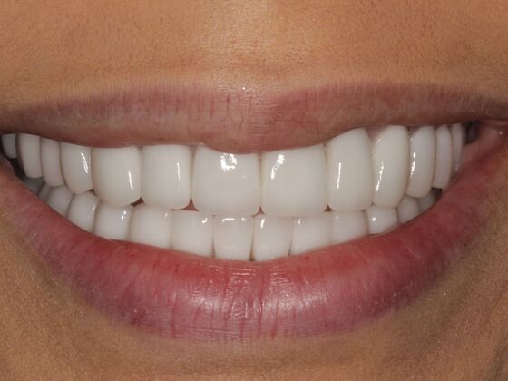 Full Mouth Rehabilitation Case 3 - After