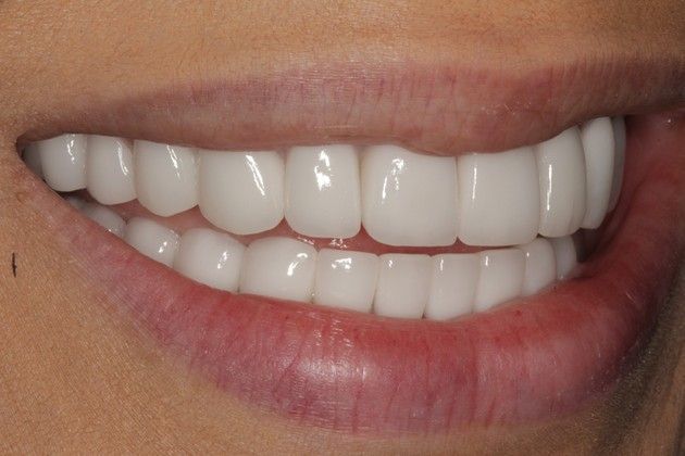 Full Mouth Rehabilitation: Severe Tooth Wear - After