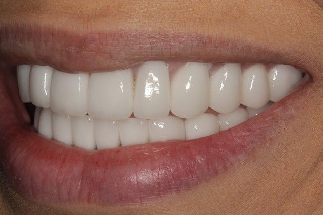 Full Mouth Rehabilitation: Severe Tooth Wear - After
