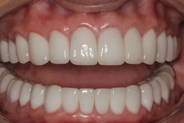 Full Mouth Rehabilitation: Severe Tooth Wear - After