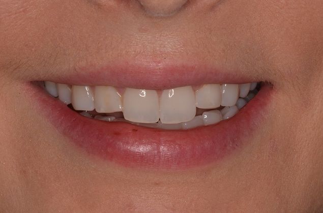 Composite Bonding: Case 5 - Before