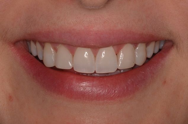 Composite Bonding: Case 5 - After