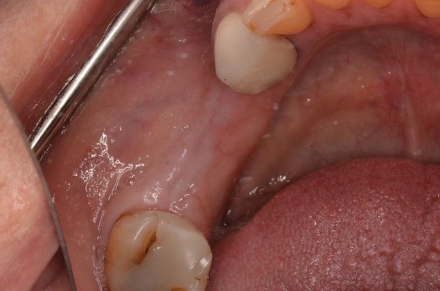 Dental Implants: Case 4 - Before