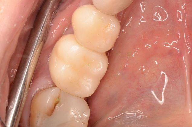 Dental Implants: Case 4 - After