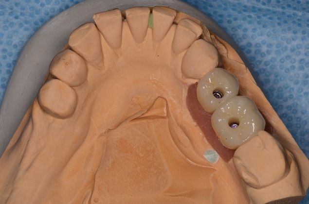 Dental Implants: Case 4 - Before