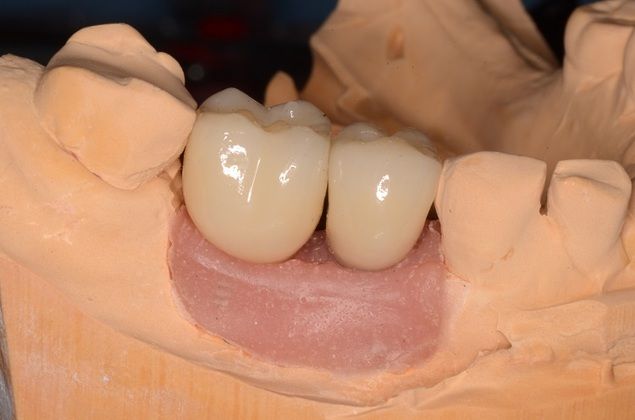 Dental Implants: Case 4 - After