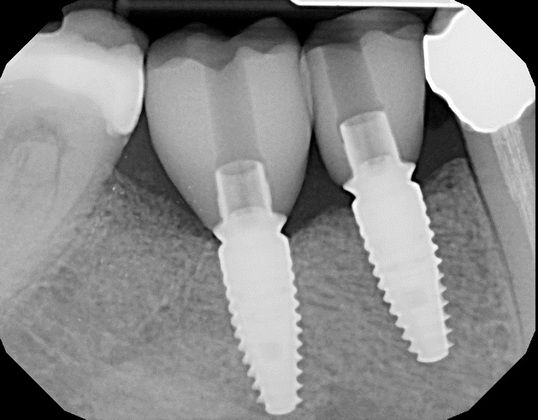 Dental Implants: Case 4 - Before