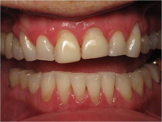 Cosmetic Crowns Case 1 - Before