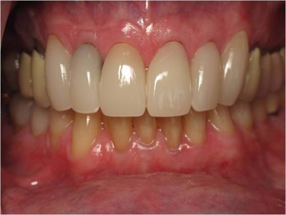 Cosmetic Crowns Case 2 - After