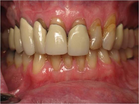 Cosmetic Crowns Case 2 - Before