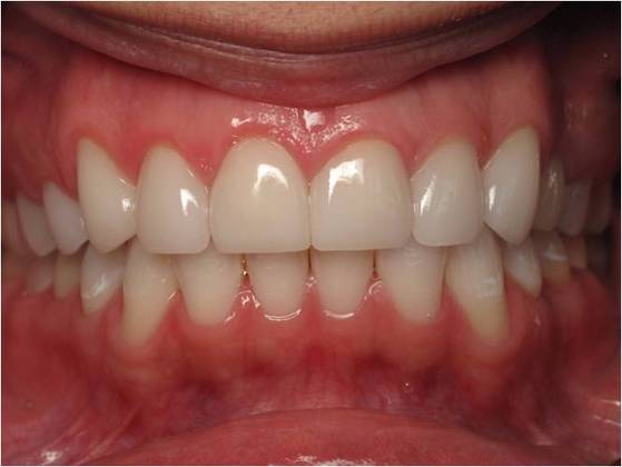 Cosmetic Crowns Case 3 - After