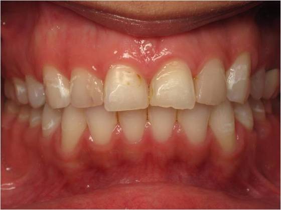 Cosmetic Crowns Case 3 - Before