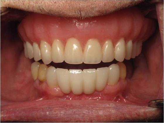 Traditional Dentures Case 1 - After