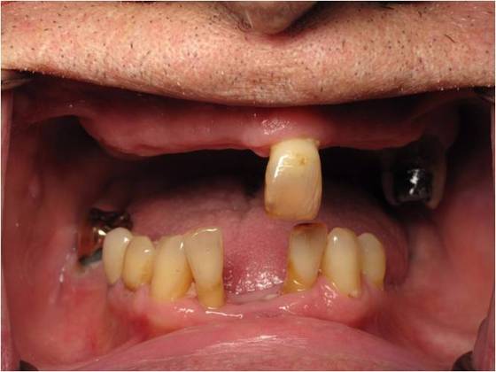 Traditional Dentures Case 1 - Before