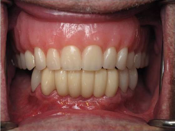 Traditional Dentures Case 2 - After