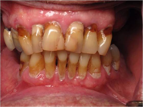 Traditional Dentures Case 2 - Before