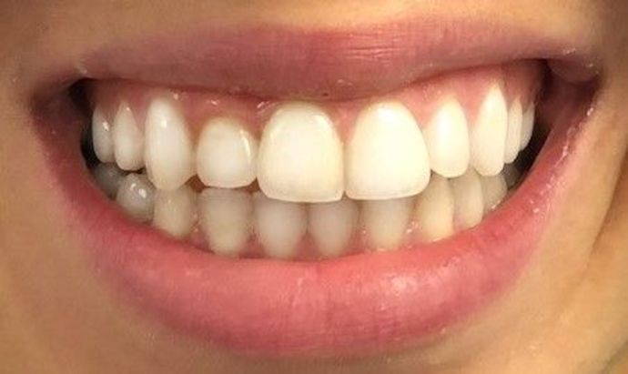 Invisalign Case 1 - After