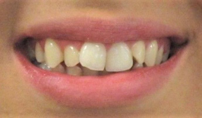 Invisalign Case 1 - Before
