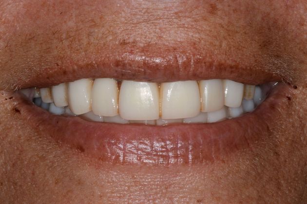 Crowns Case 1 - Before