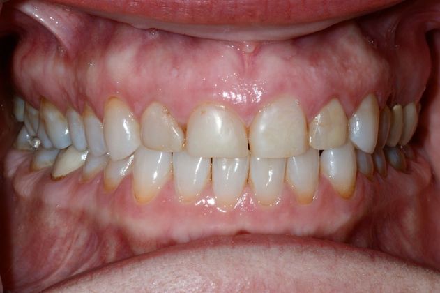 Porcelain Veneers/Crown Combination: Case 2 - Before