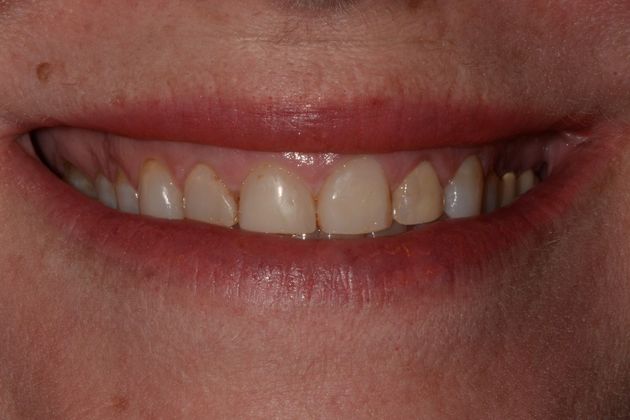 Porcelain Veneers/Crown Combination Case 2 - Before