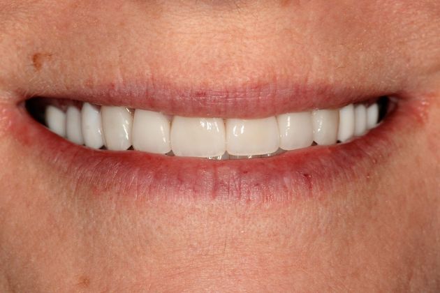 Porcelain Veneers/Crown Combination Case 2 - After