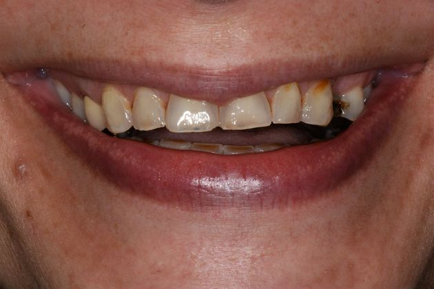 Full Mouth Rehabilitation Case 1 - Before