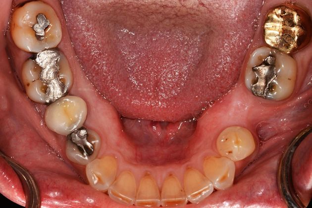 Full Mouth Rehabilitation: Case 1 - Before