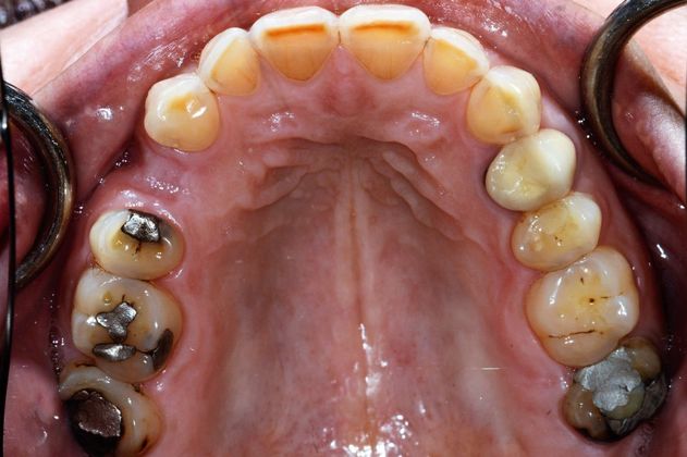 Full Mouth Rehabilitation: Case 1 - Before