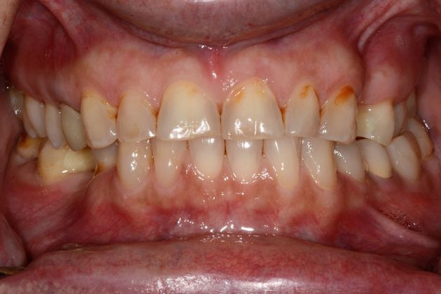 Full Mouth Rehabilitation: Case 1 - Before