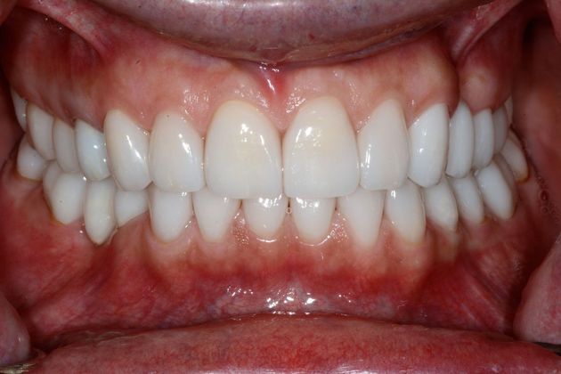 Full Mouth Rehabilitation: Case 1 - After