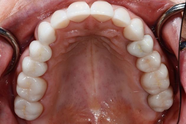 Full Mouth Rehabilitation: Case 1 - After