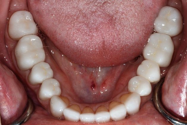 Full Mouth Rehabilitation: Case 1 - After