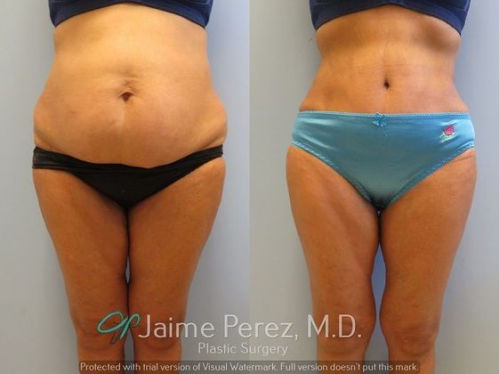 63 year old - Lipoabdominoplasty - Abdominoplasty/Tummy Tuck - Before and  After Gallery